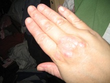hand psoriasis after